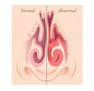 Nasal Concha Surgery