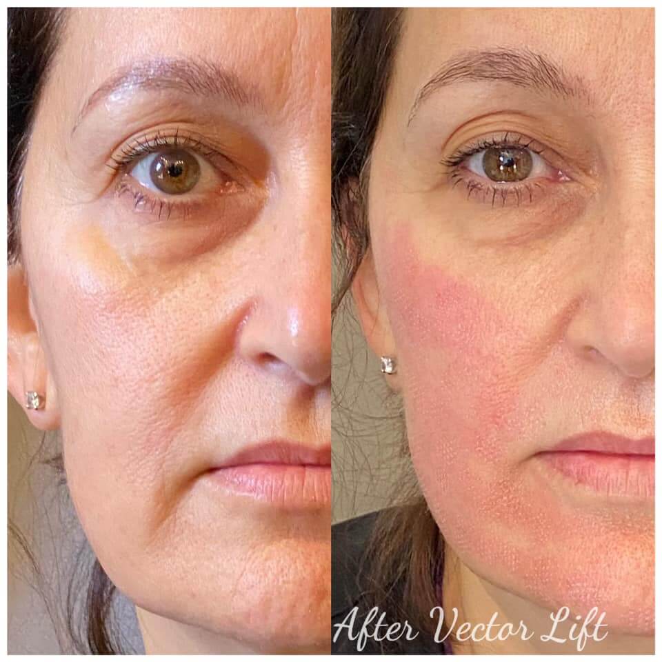 Face Lifting