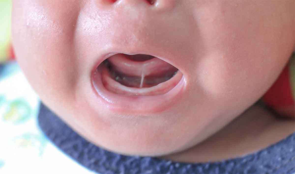 Ankyloglossia