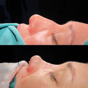 Are the stitches removed after rhinoplasty?